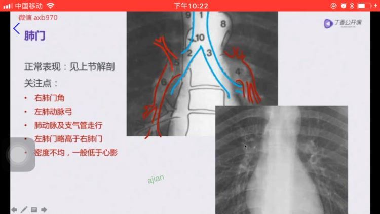 丁香园：胸部x线(新完结)