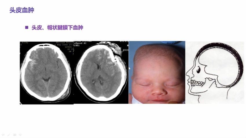 丁香园：手把手教你读懂头颅 CT【共10节】【全】【298元】